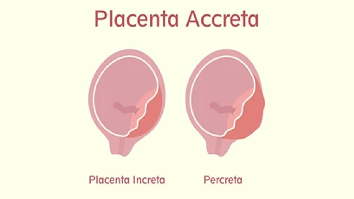 placentra-accreta