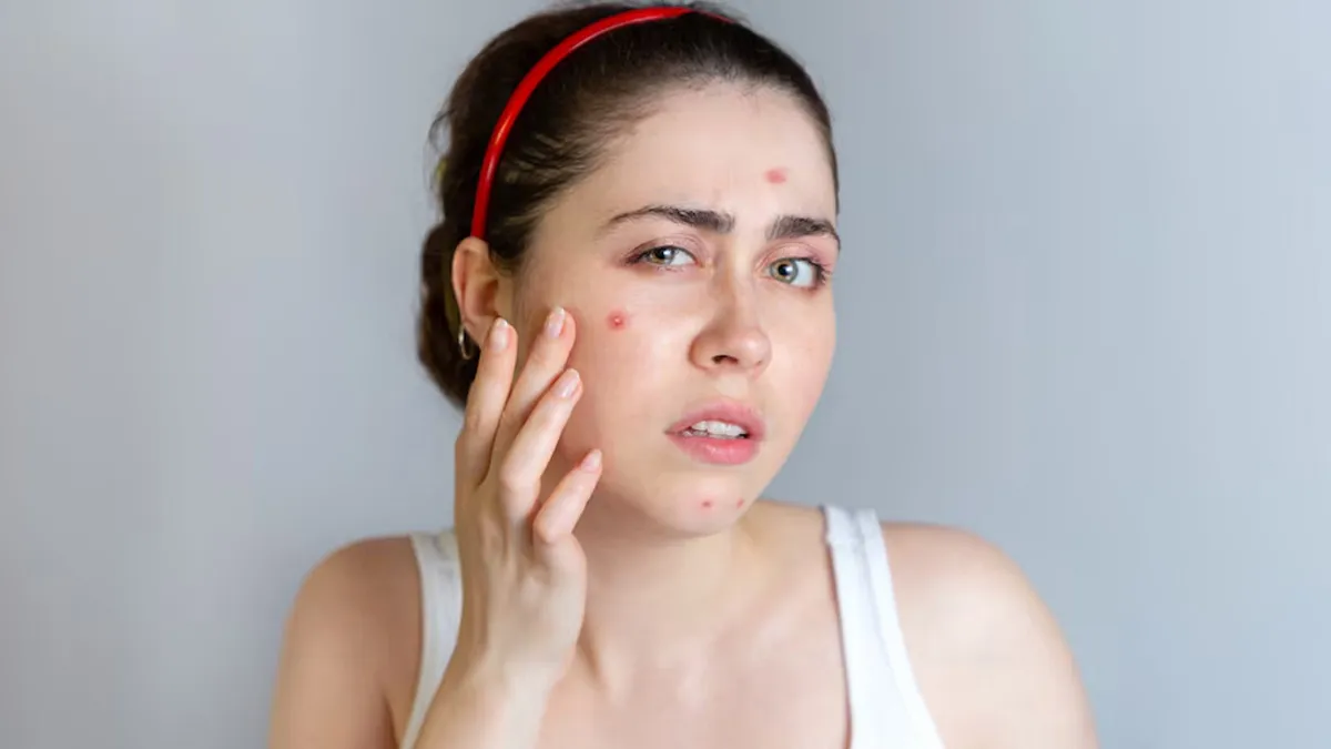 Can Protein Supplements Be the Culprit Behind Your Acne Problems?