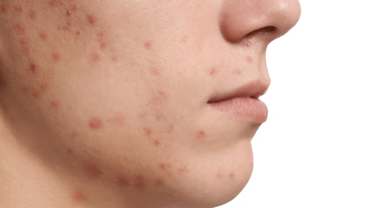 3-protein-suplements-and-acne