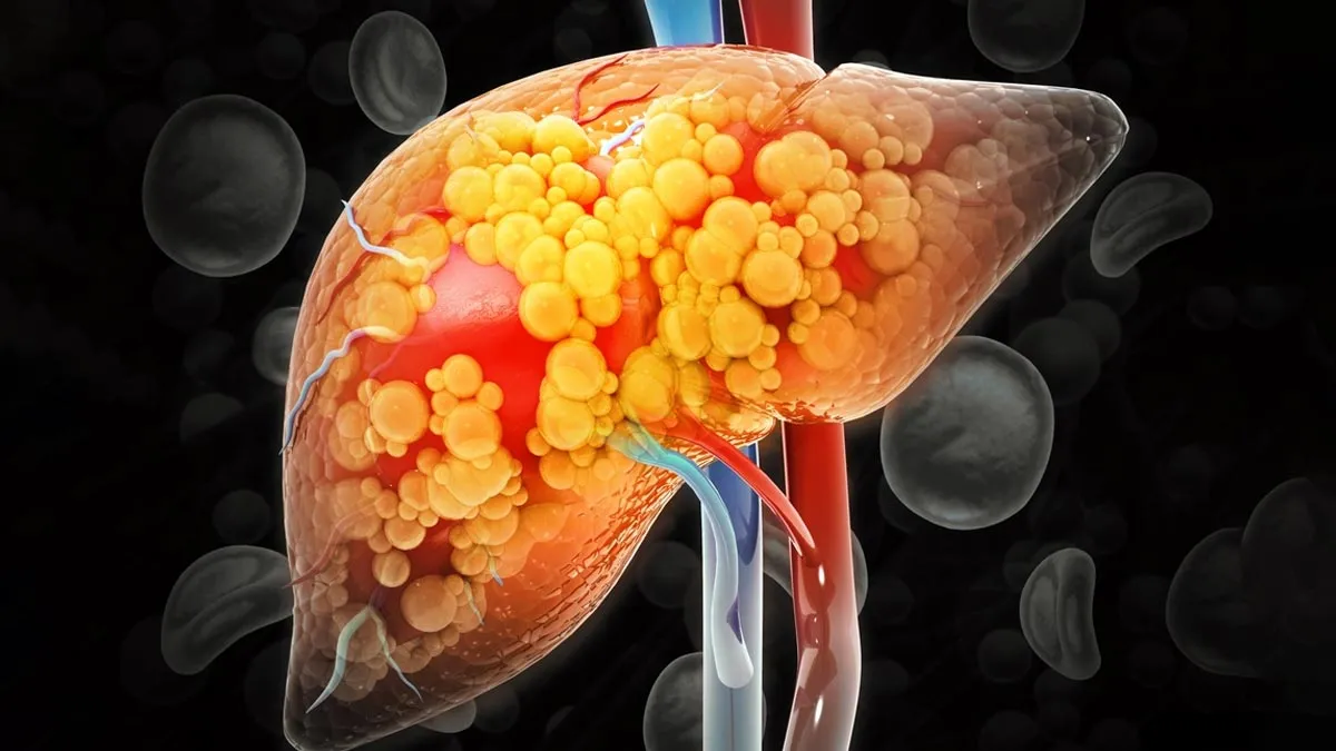What Is Grade 3 Fatty Liver And What Should You Do If You Are Diagnosed With It