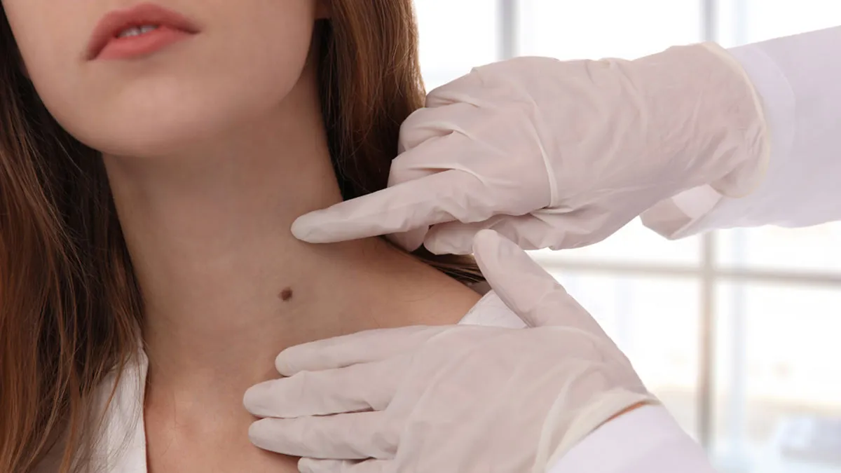 Opting For Skin Tag Removal Patches? Expert Explains If They Are Safe To Use