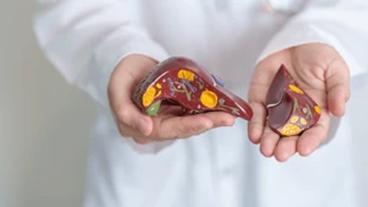 1-grade-3-fatty-liver