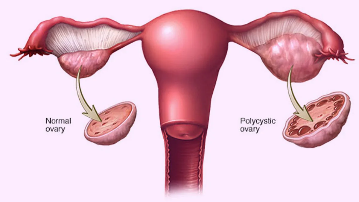 Expert Shares 5 Dinner Ideas To Lose PCOS Belly Fat While Enjoying Your Favourite Foods