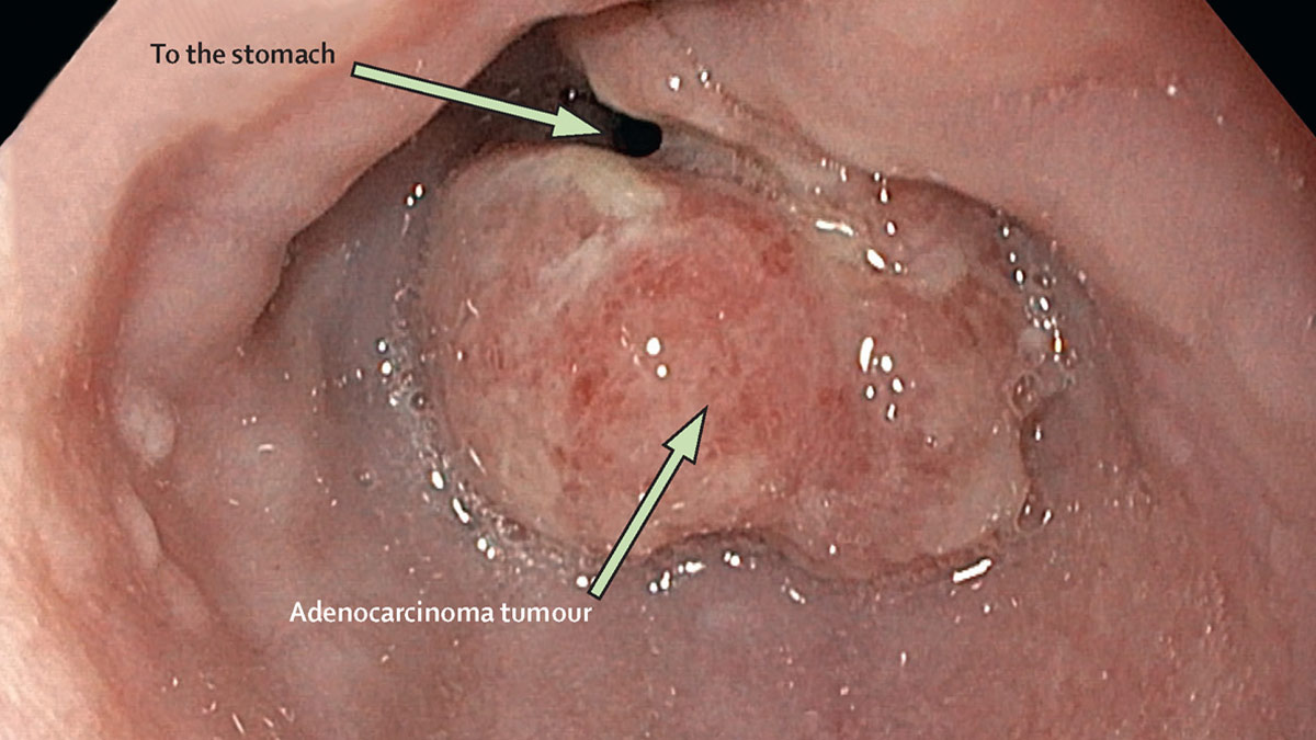 2-oesophageal-cancer