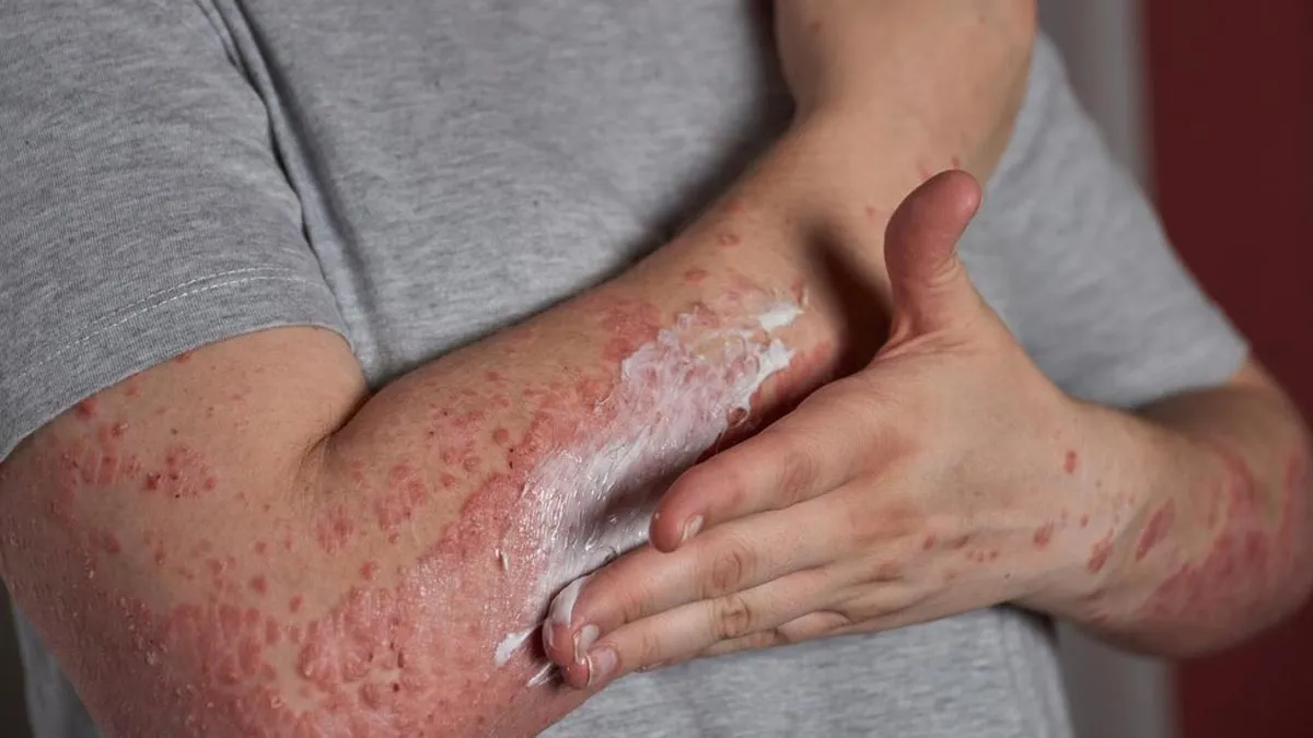 Debunking Myths: Poor Hygiene Doesn’t Cause Psoriasis – Five Other Common Misconceptions

