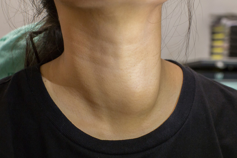 thyroid-swelling