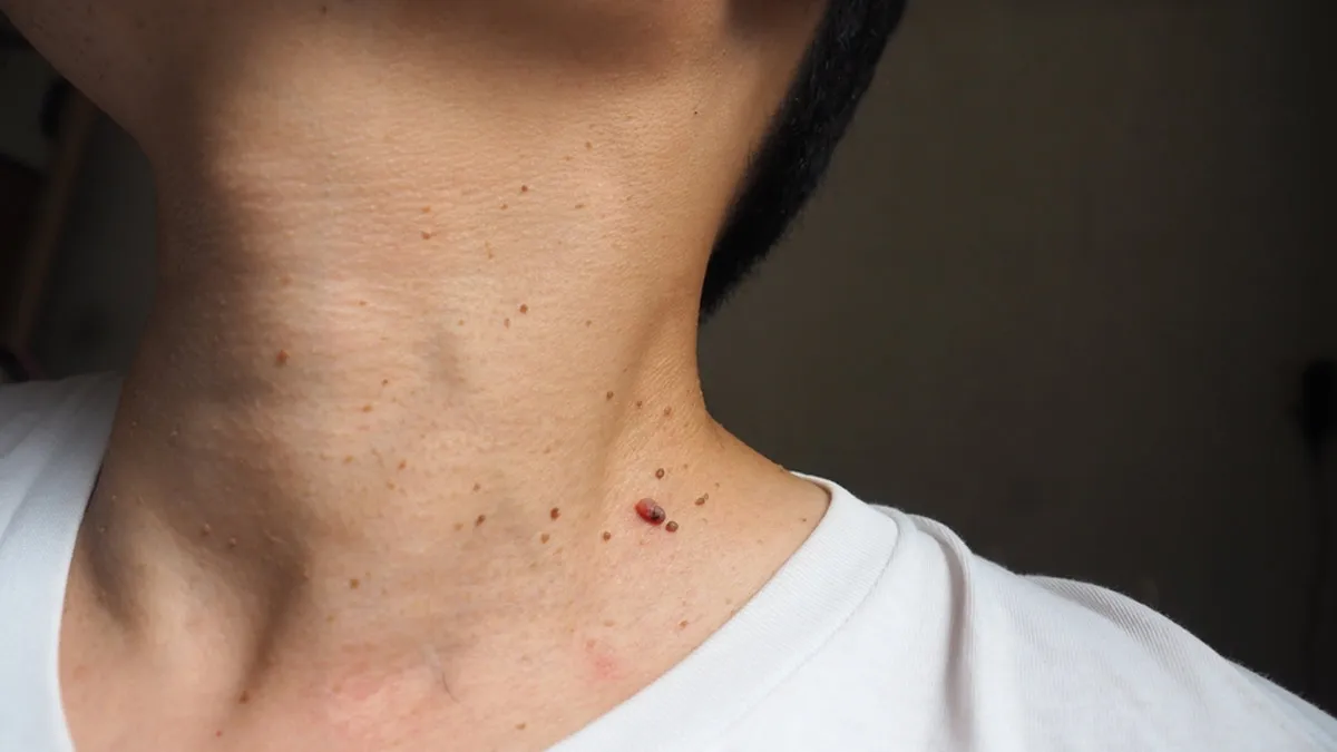 Why Some People With Diabetes Develop Skin Tags