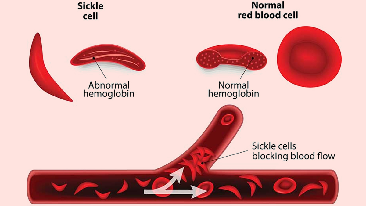 1-sickle