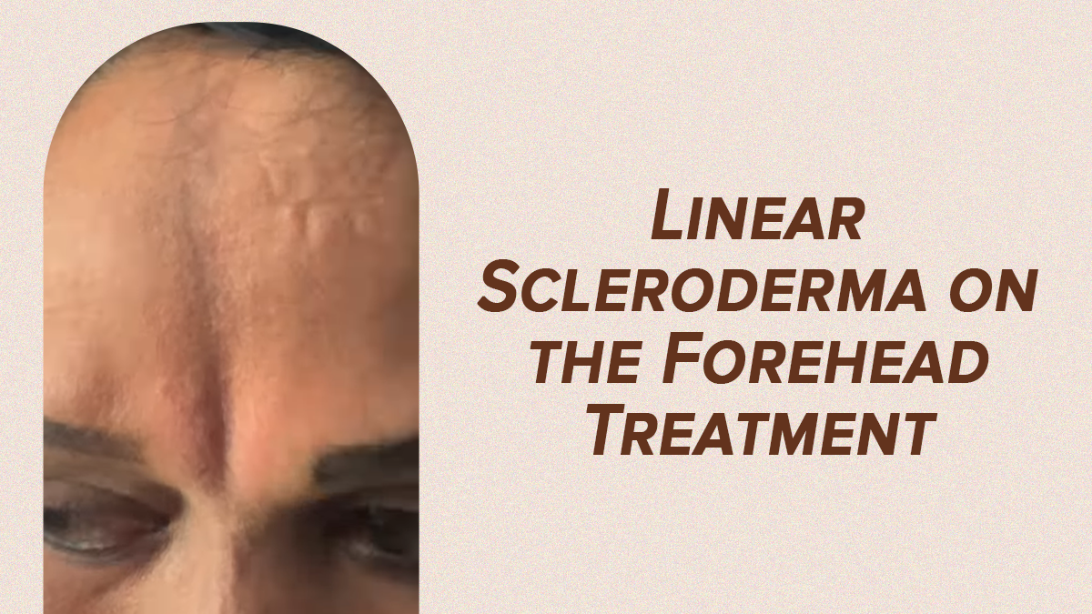 How to Treat Linear Scleroderma on the Forehead: Expert Explains Causes & Treatment