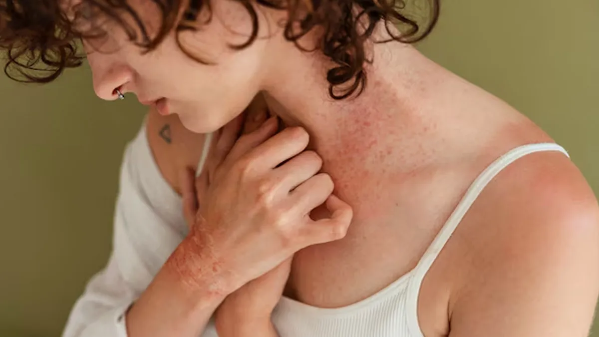 Why Some People Develop Skin Rash When Stressed: Expert Explains
