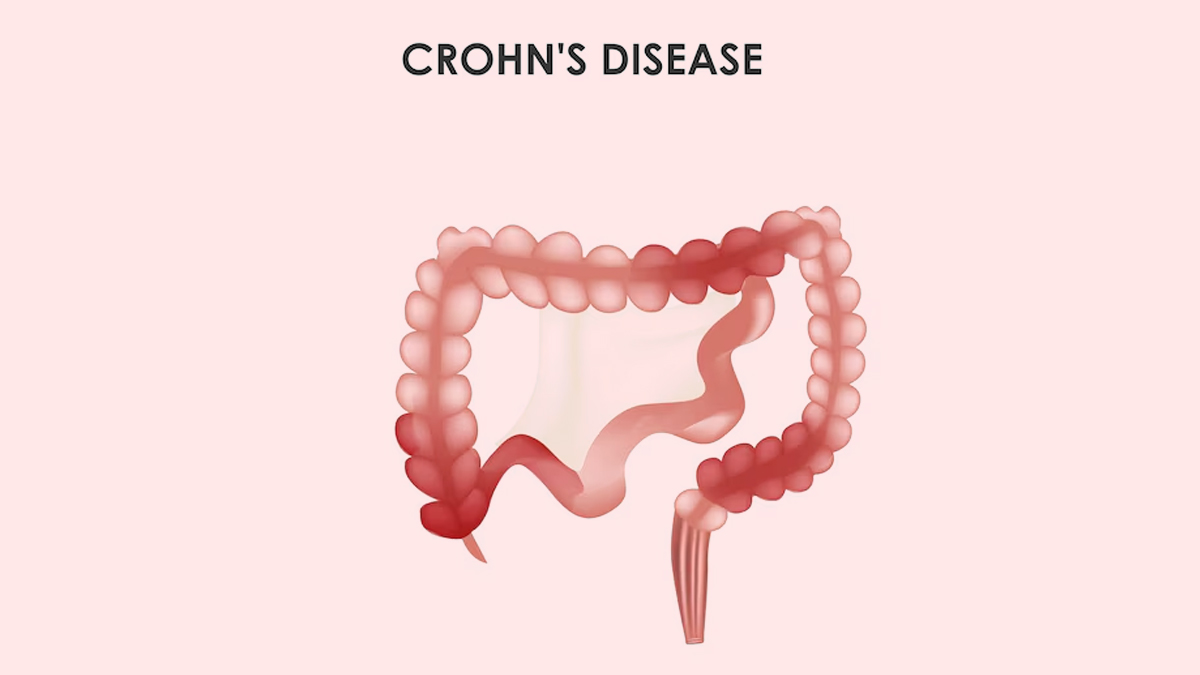 Crohn's-disease