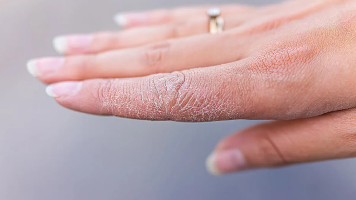 Struggling With Dryness Between Fingers? Here's Your One-Stop Solution