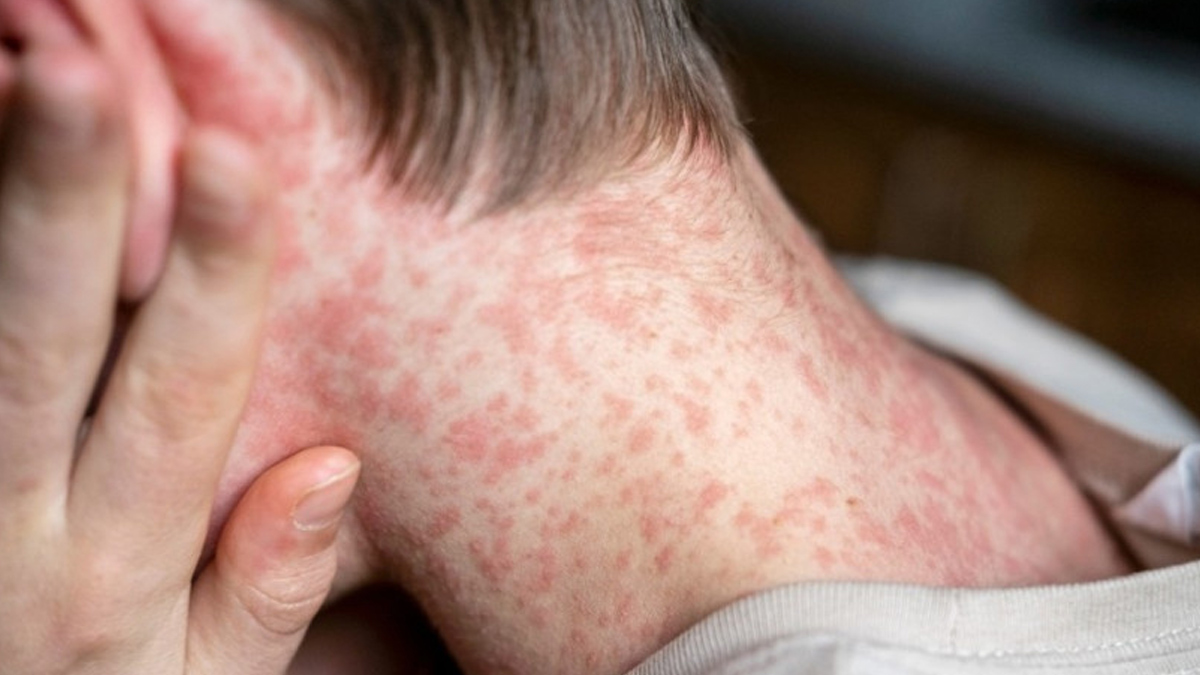 1-measles
