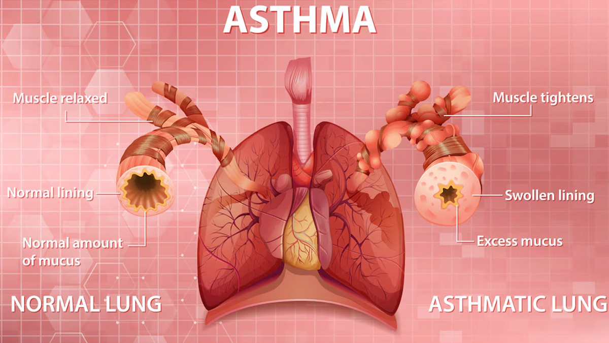 2-Asthma