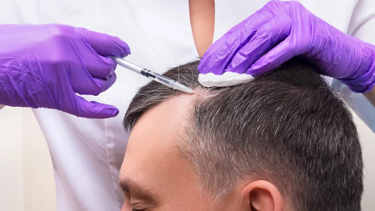 Are Hair Transplants Truly Sustainable? Doctor Shares Insights