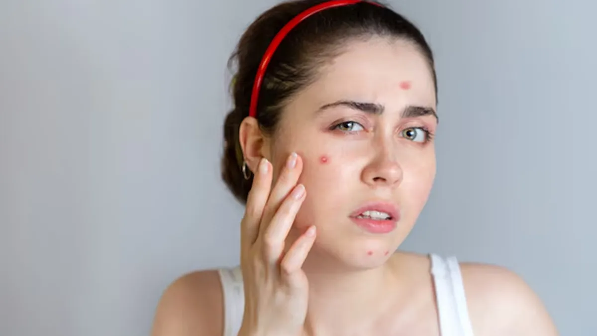 Say Goodbye to Acne With This Antibacterial Honey and Cinnamon Face Mask, How To Make It