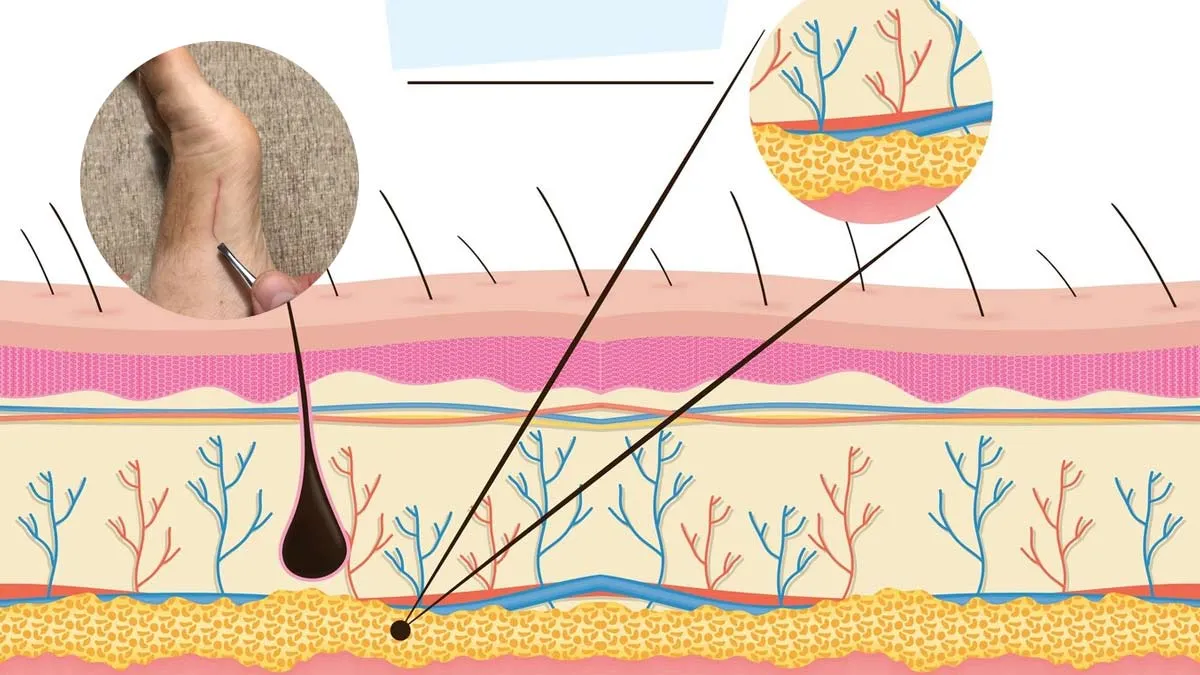 Everything You Need to Know About Hair Splinters: Causes, Symptoms, and Solutions