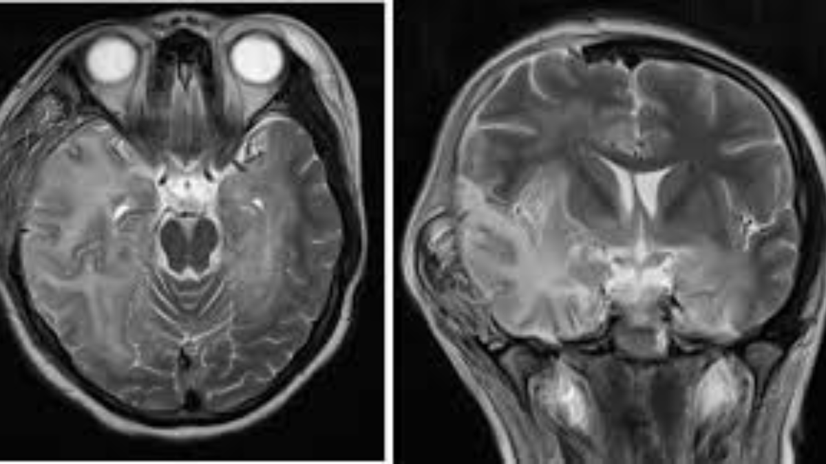 WHO Declares Encephalitis A Global Health Emergency Amid Rising Cases