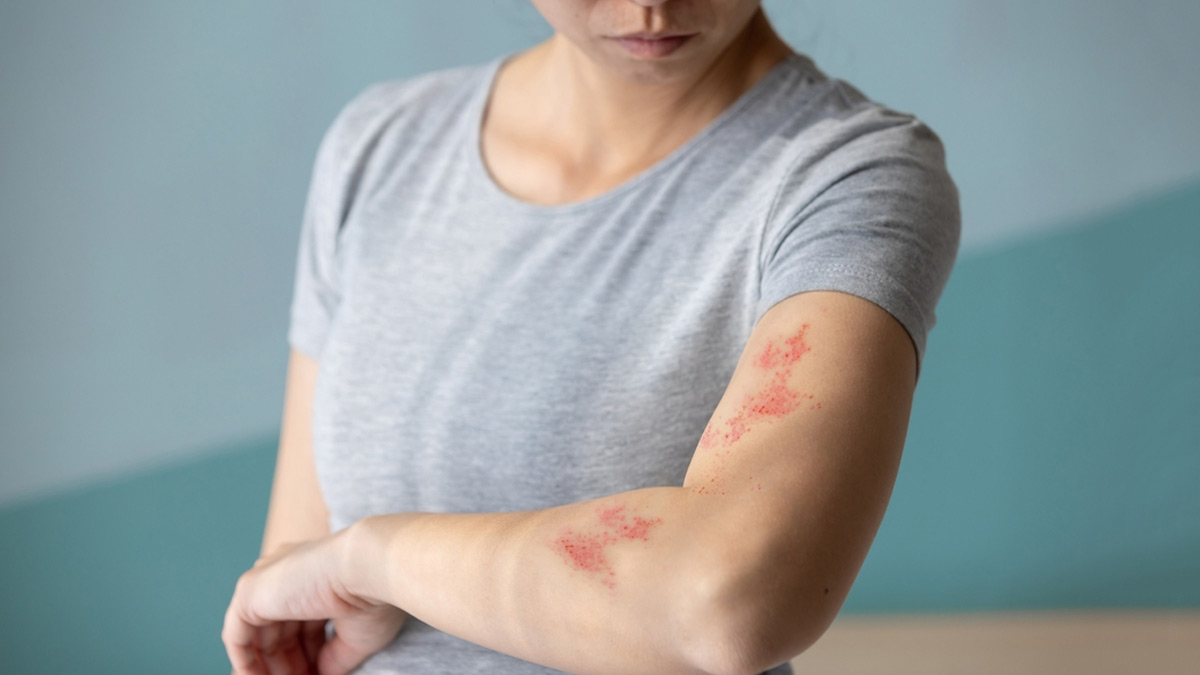 Shingles Awareness Week: Expert Explains Why Shingles Is More Than Just ...