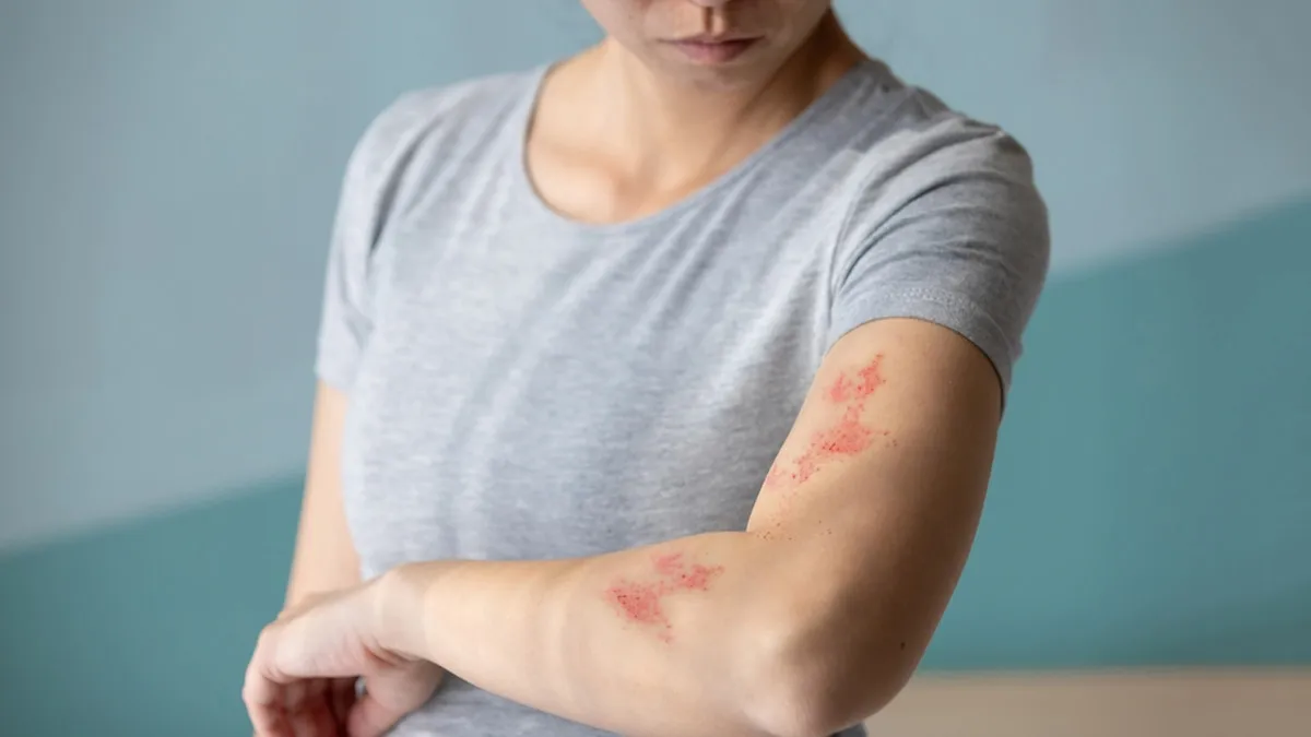 Shingles Awareness Week: Expert Explains Why Shingles Is More Than Just A Rash