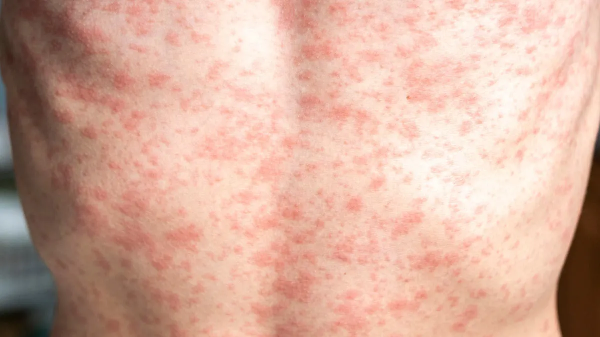 Measles Outbreak Turns Deadly In Texas: First Fatality Reported As Cases Exceed 120