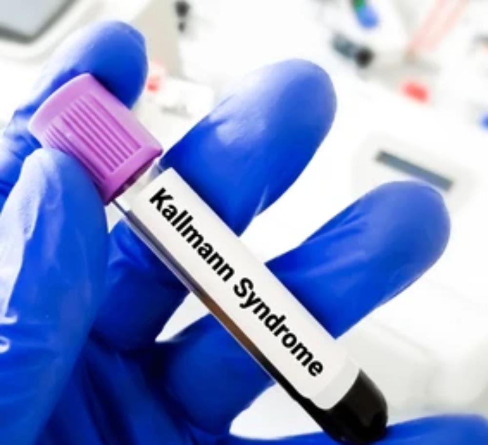Kallmann-syndrome