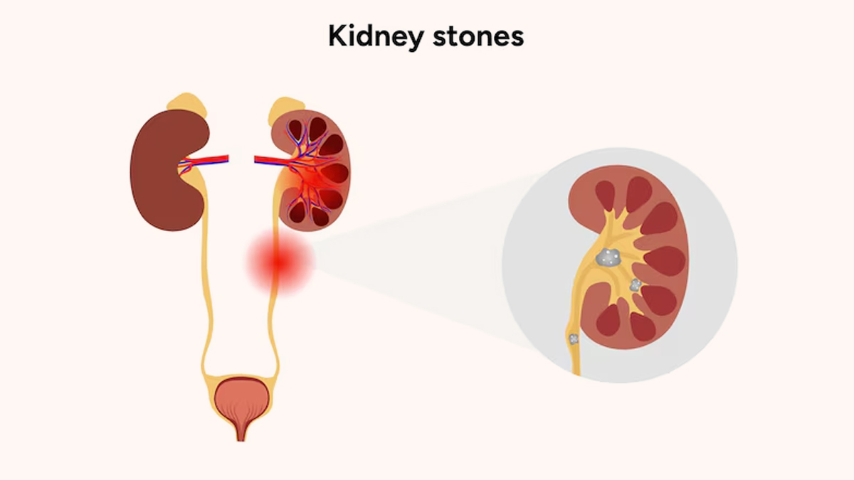 kidney-stones