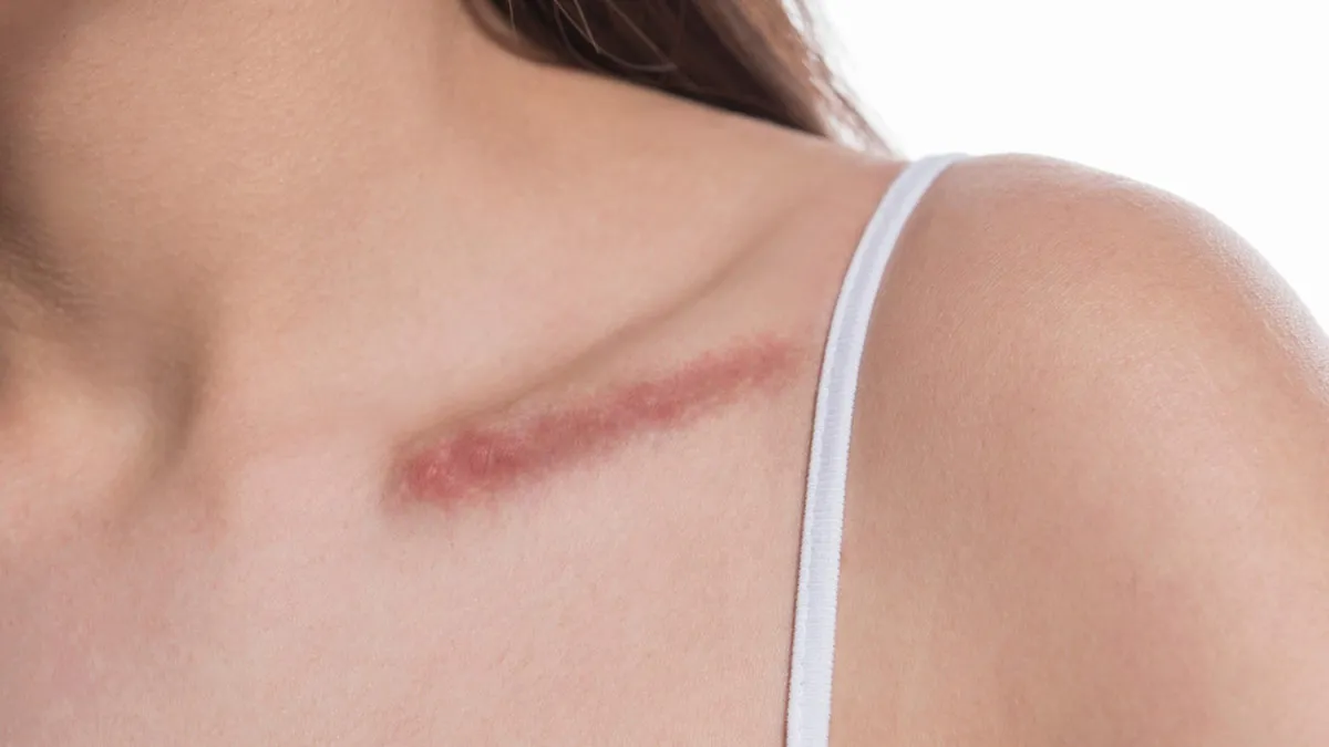 Keloids: Why Some Scars Keep Growing and How to Treat Them
