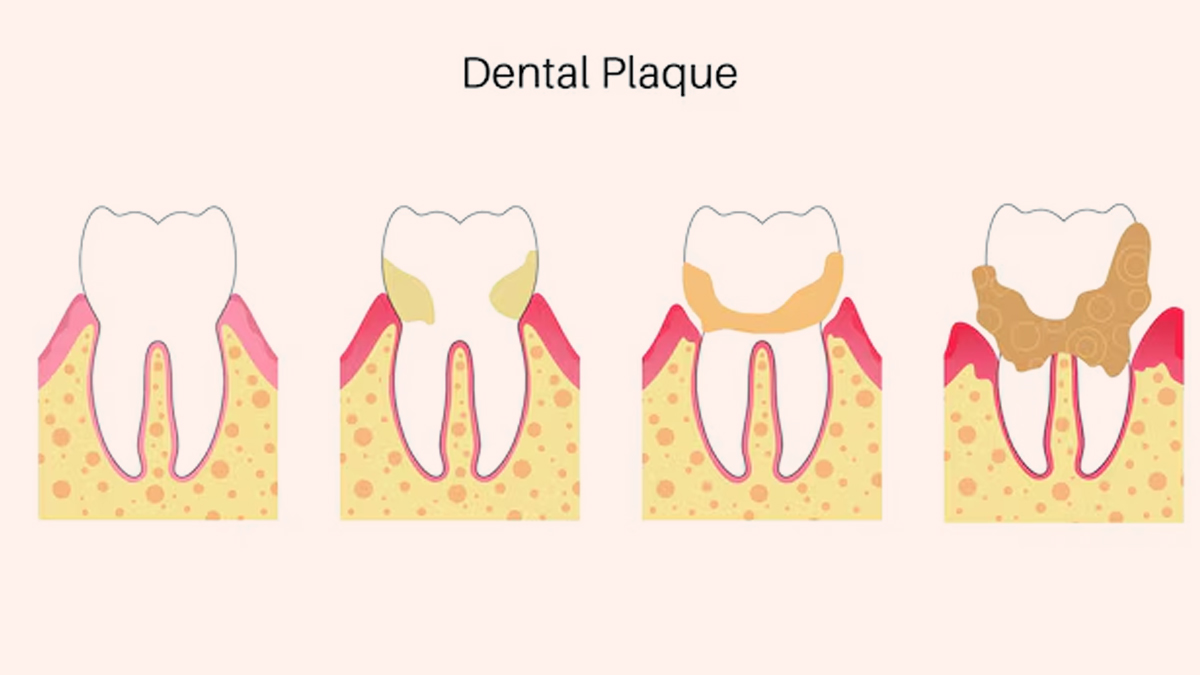 plaque-buildup