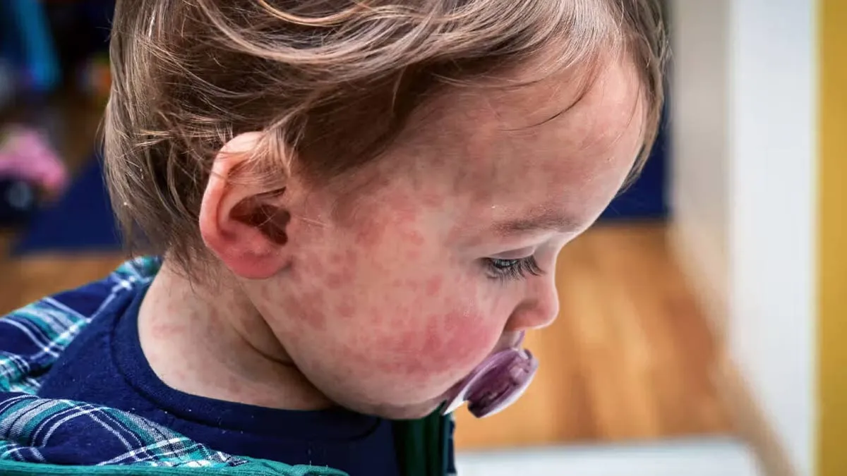Measles In US: CDC Sends Experts To Texas As Cases Exceed 159, One Fatality Reported
