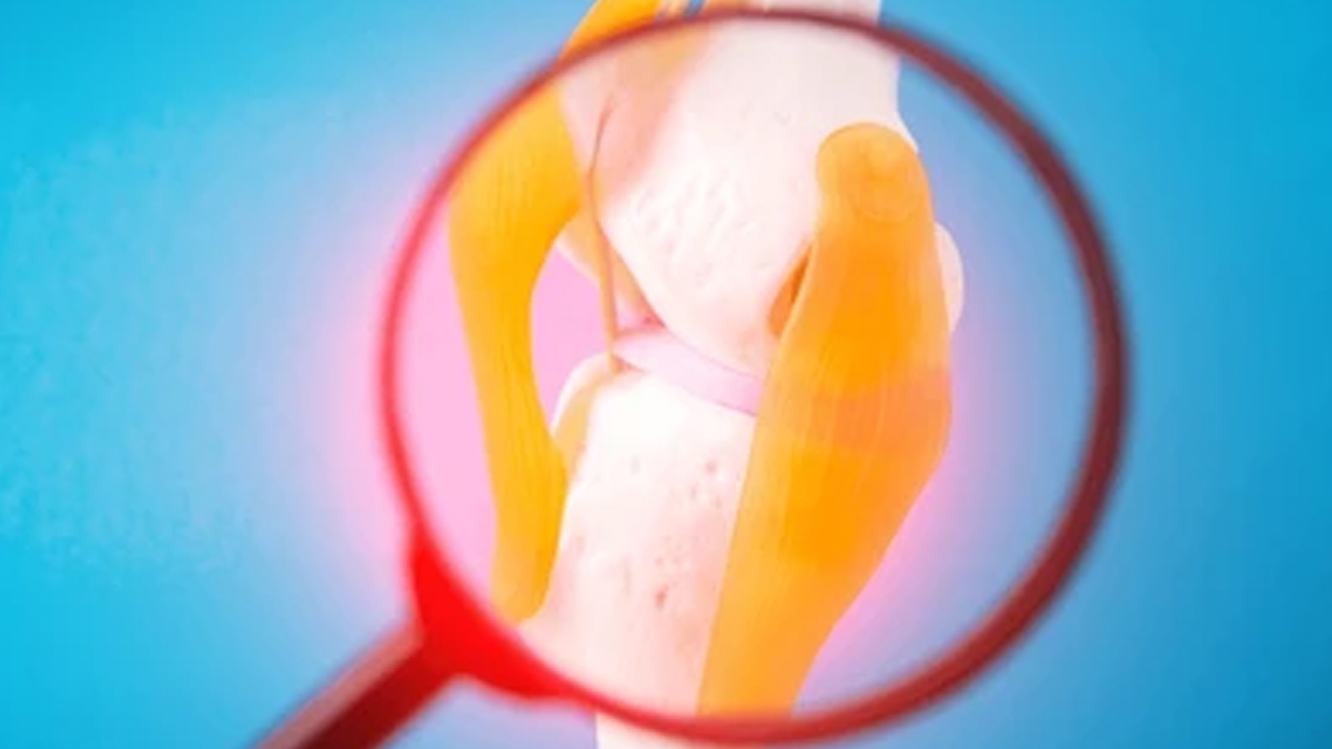 arthritis-inflmmation