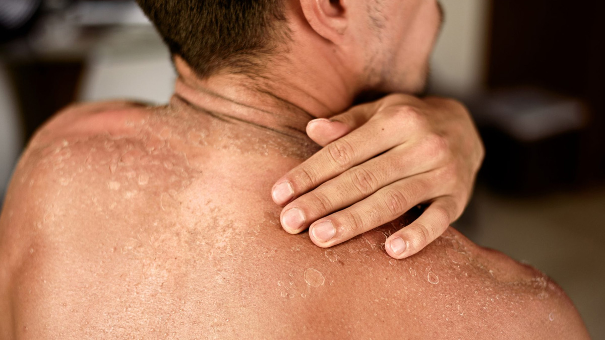 3-radiation-burns