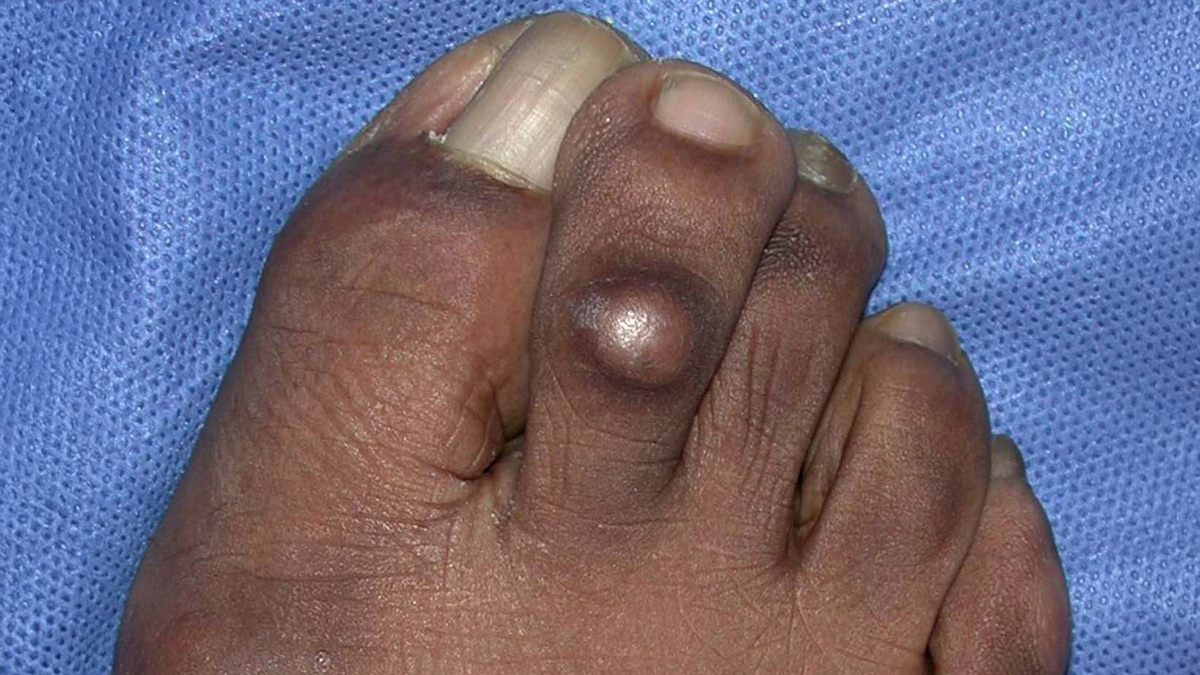 corns on feet 1 - 2025-03-12T164637.953