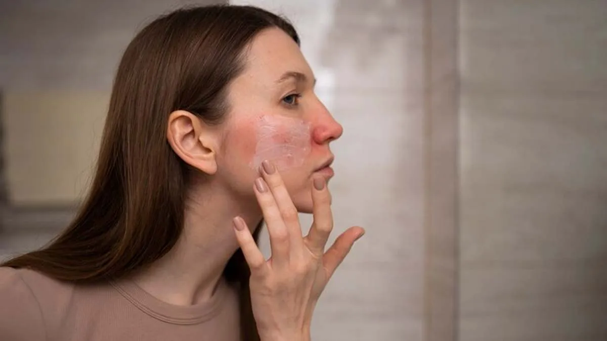 Dealing with Rosacea? Avoid These 7 Triggering Factors to Manage This Condition