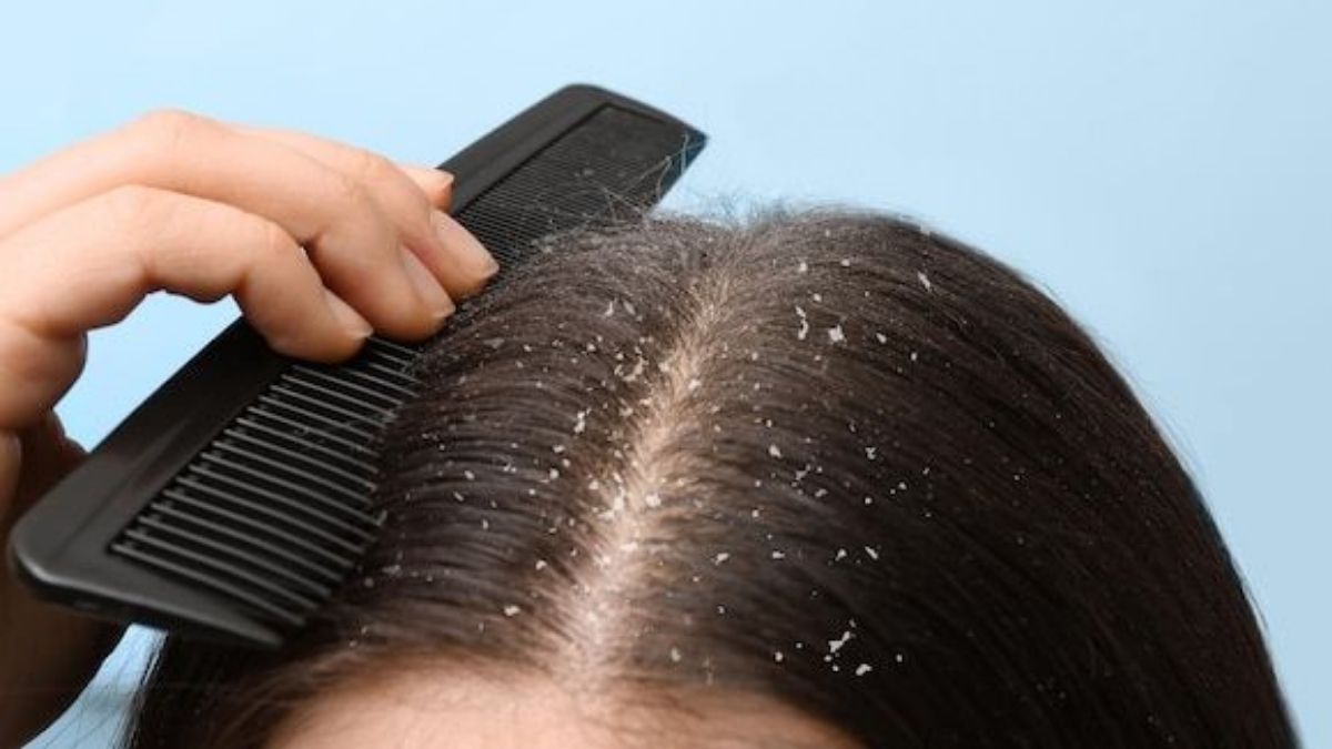dandruff and scalp dry (2)