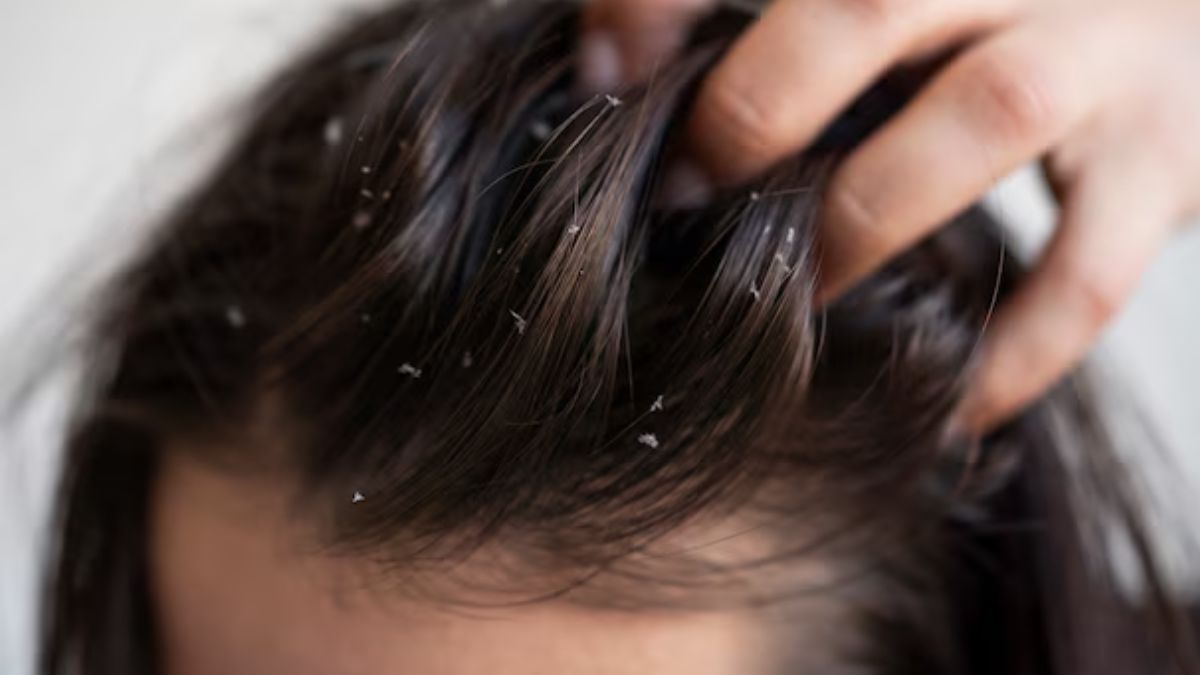 dandruff and scalp dry (3)
