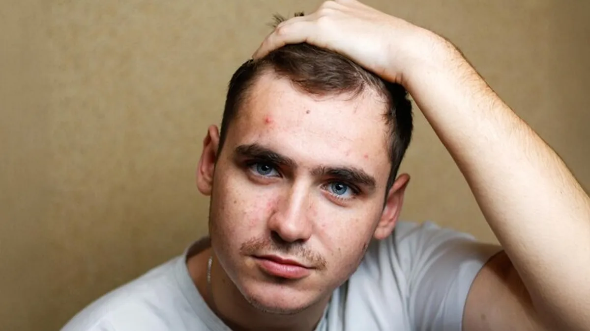 Is Acne and Hair Loss Linked To Hormones? Expert Weighs In
