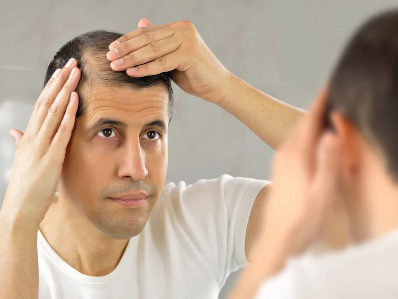 Instagram Leads or Misleads: Can Smoking Actually Cause Hair Fall? Find Out Here