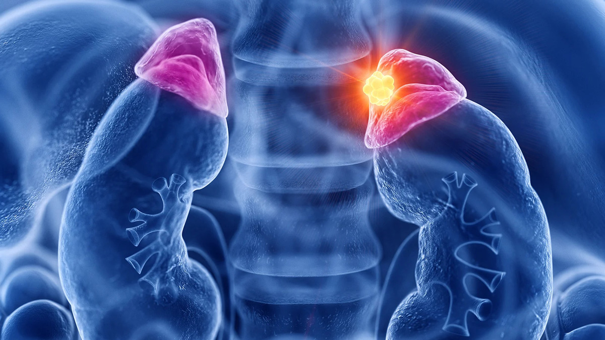 2-Adrenocortical-Carcinoma