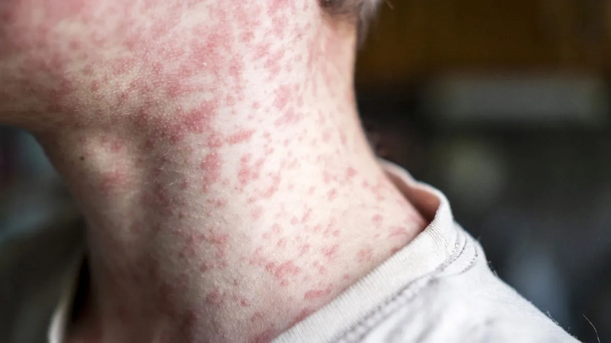 Texas Measles Outbreak Surges To 279 Cases, Nearing 2024 US Total; Health Officials On High Alert