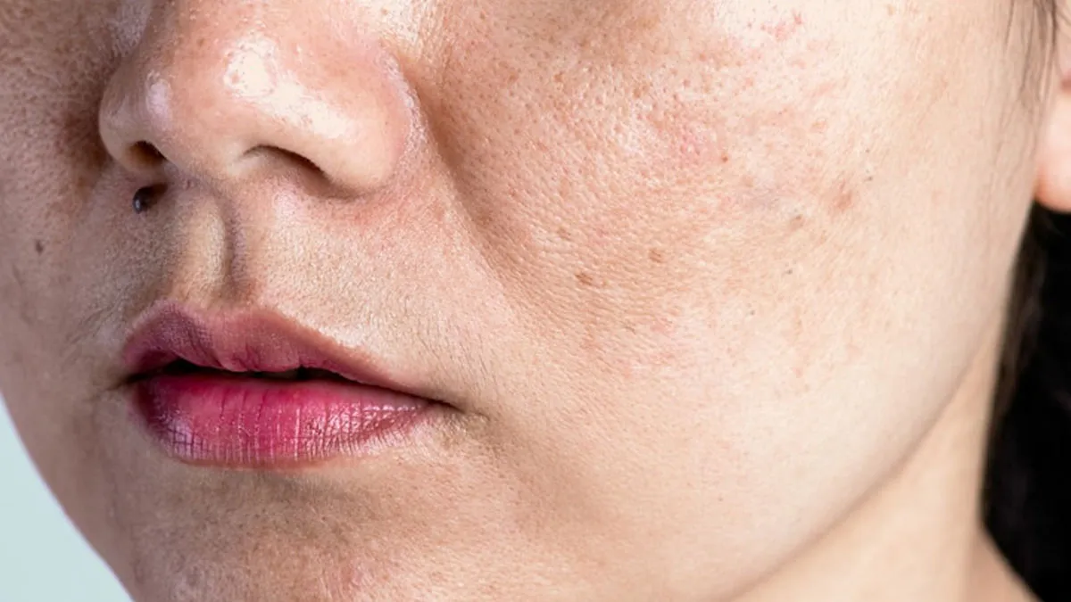 Struggling With Pigmentation? Try THIS Sure-Shot Way To Get Rid Of Them In Weeks