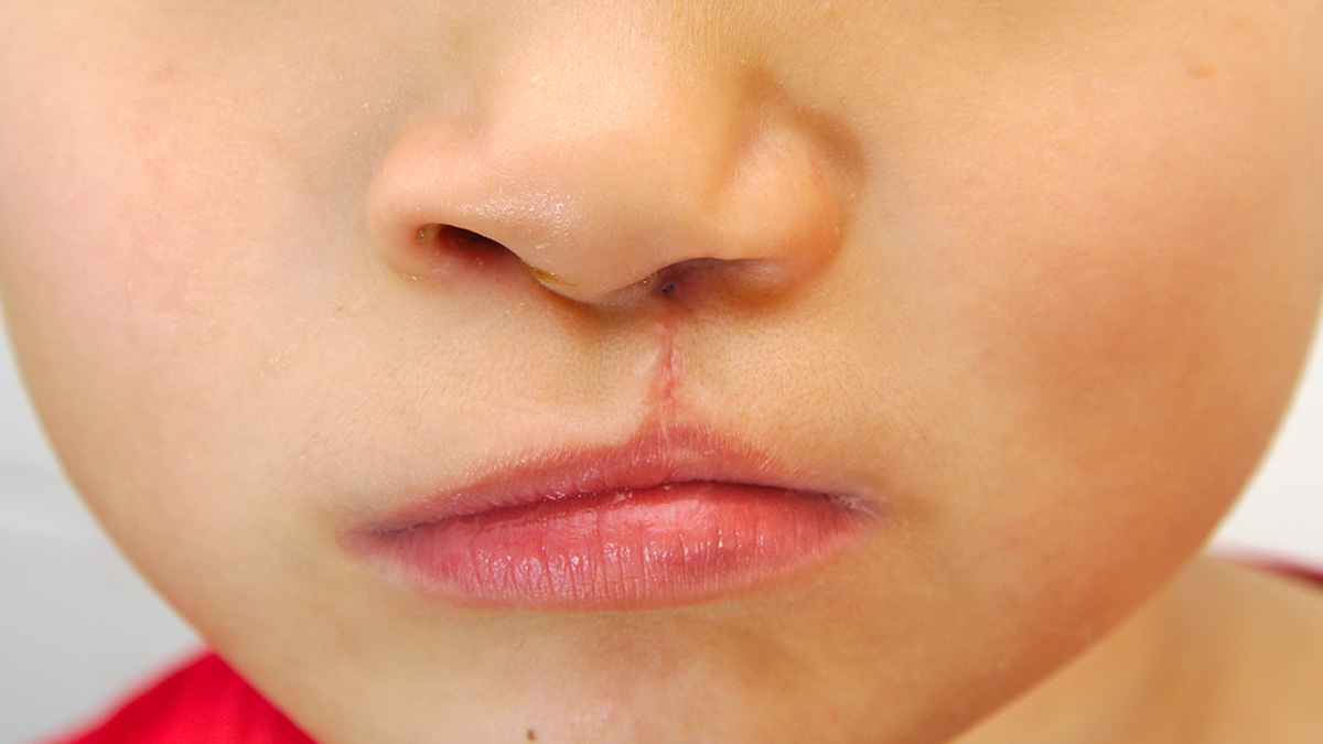 cleft-lip