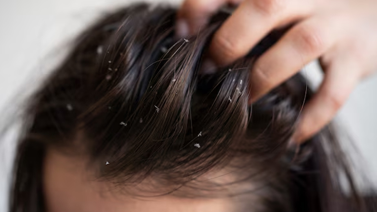 dandruff