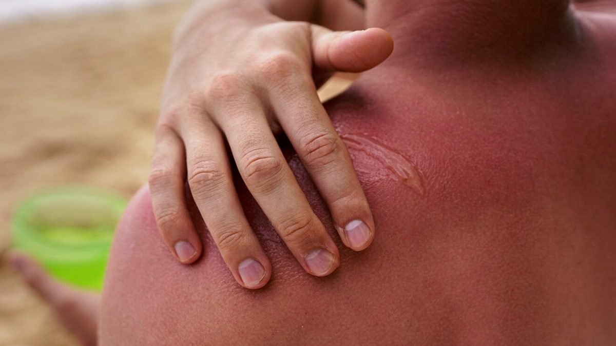 sunburn