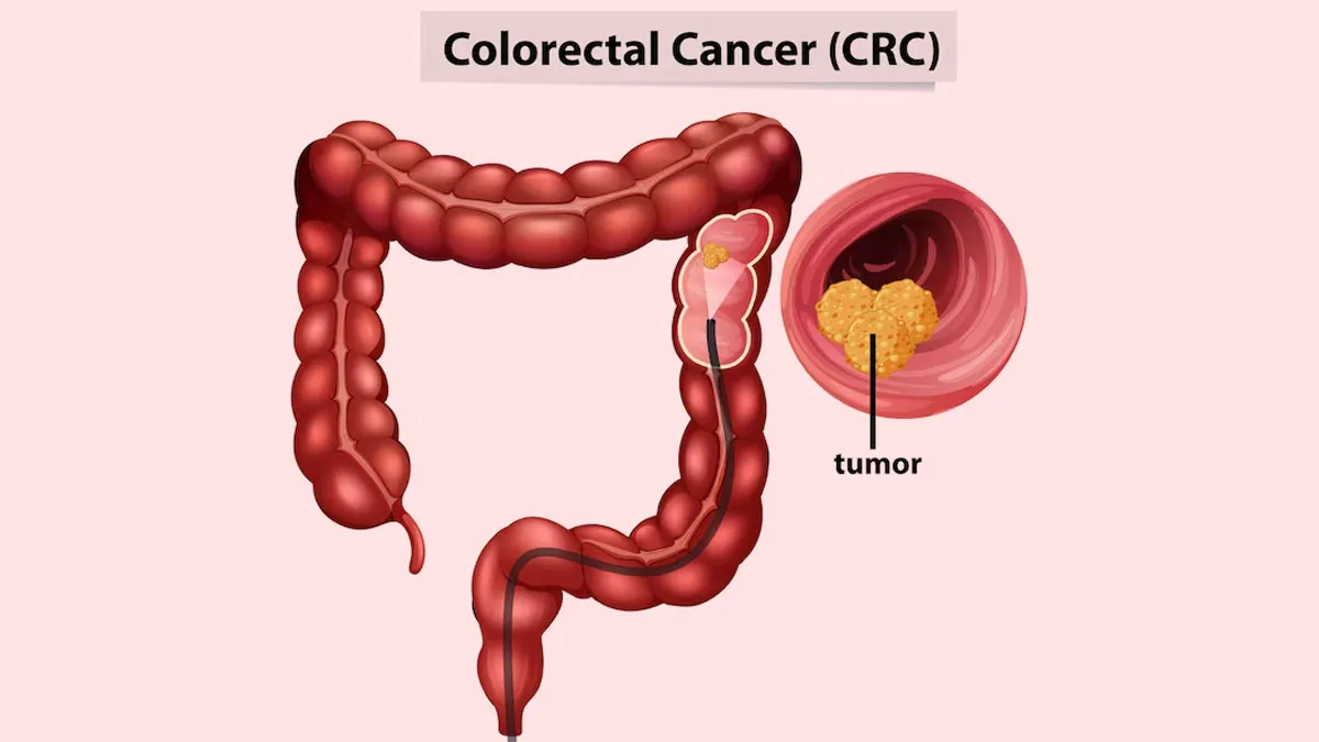 Colorectal Cancer: Expert Explains How to Detect Early Symptoms and Take Preventive Action
