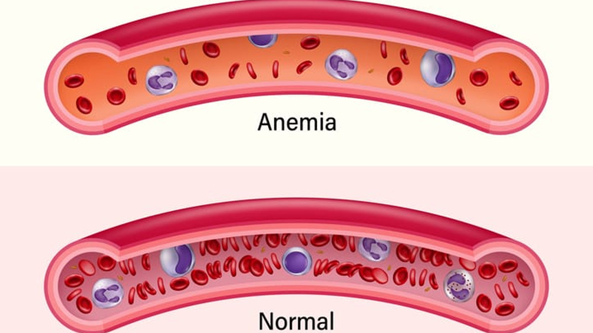 1-anaemia