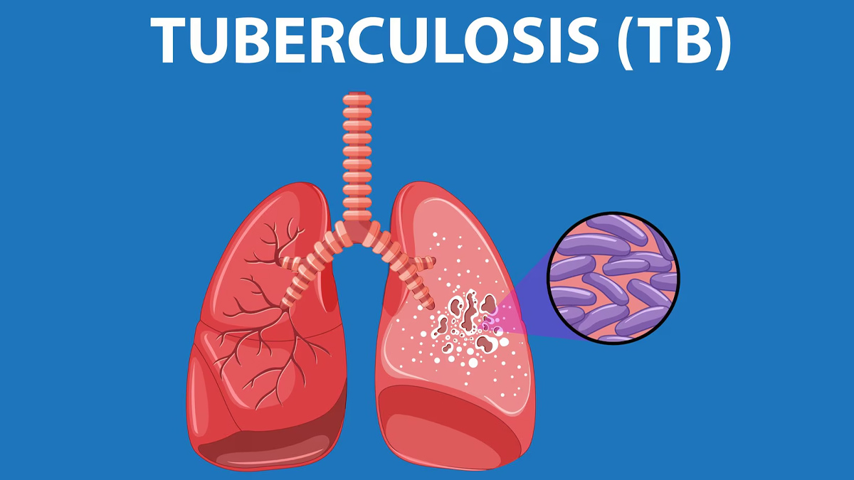 tuberculosis