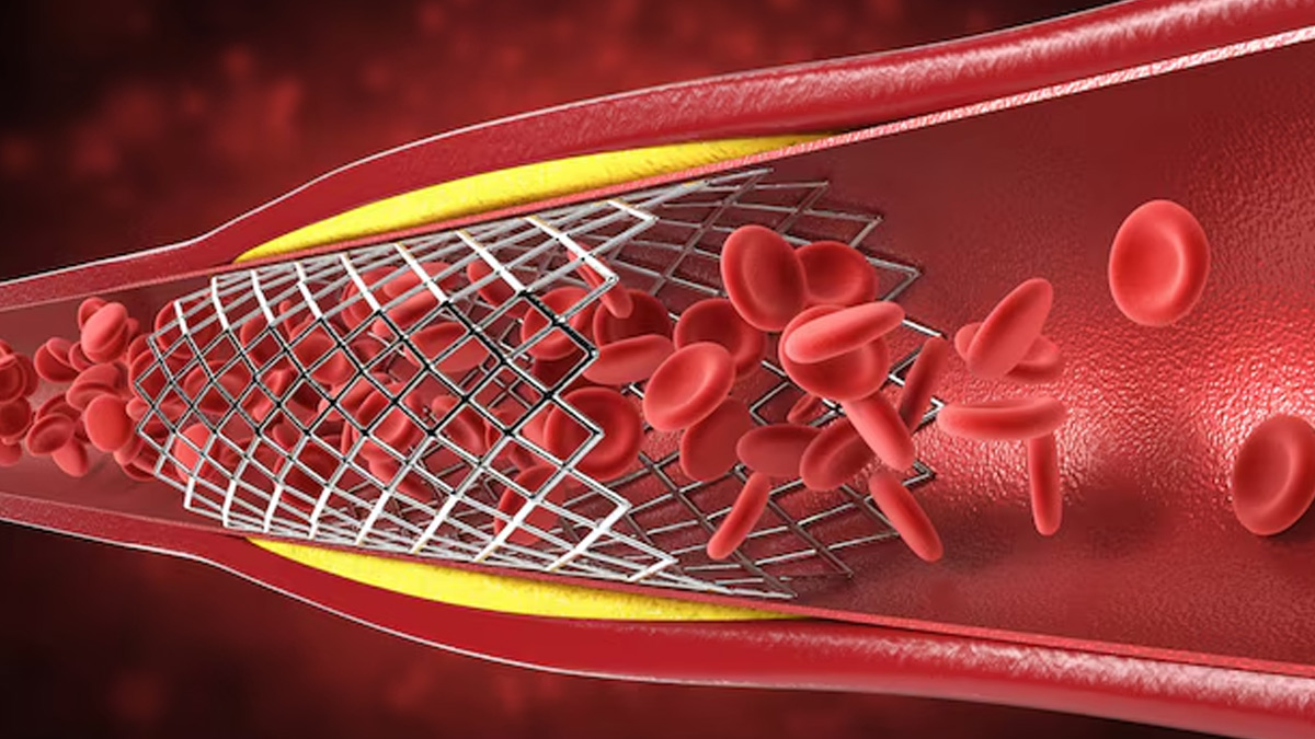 angioplasty 1 - 2025-03-25T123157.253