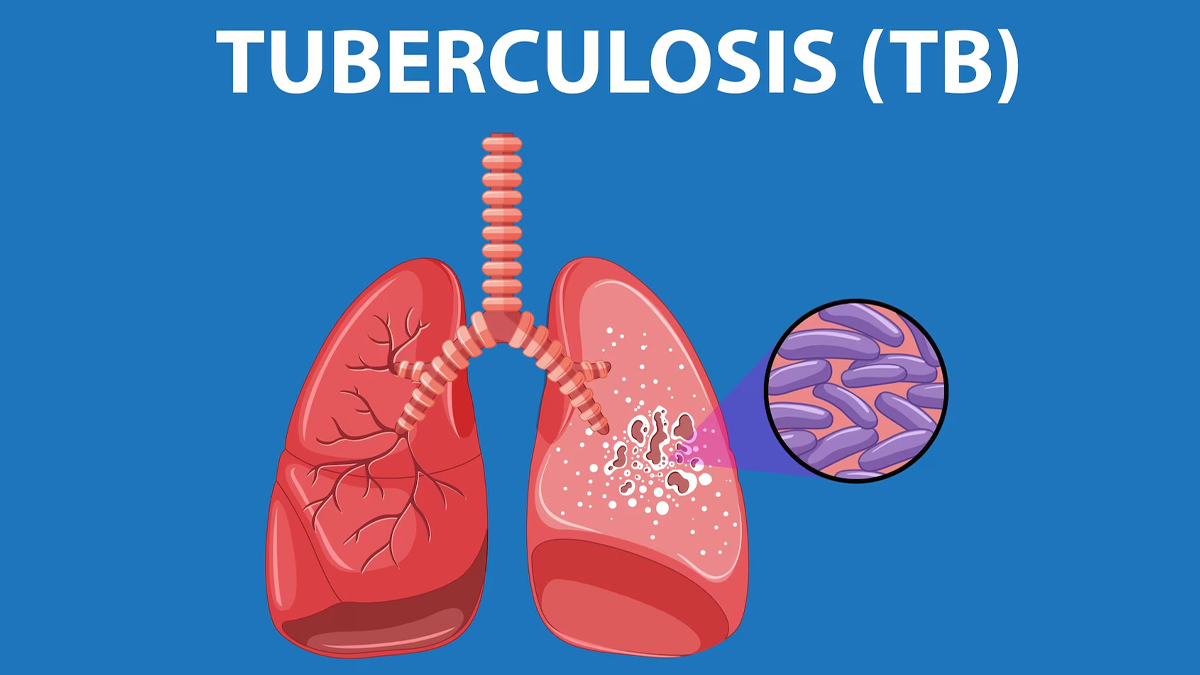 Tuberculosis
