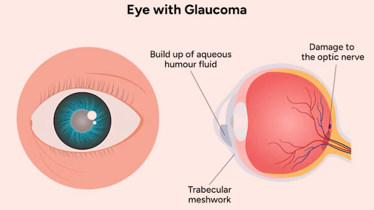 glaucoma